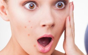 下巴长痘痘是什么原因？痤疮和粉刺有什么区别？